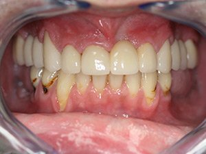 Person with healthy restored smile