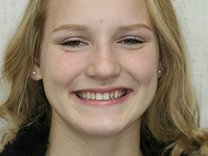 Girl with misaligned teeth