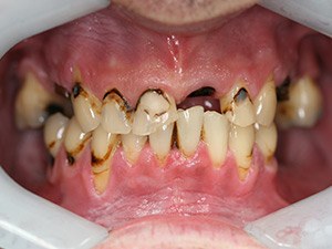 Person with severely damaged teeth