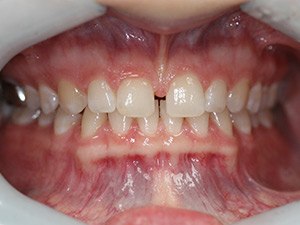 Person with gaps between teeth