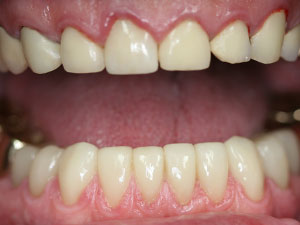 Person with fully restored bottom teeth
