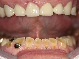 Person with very damaged bottom teeth