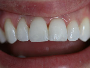 Patient with two restored and healthy teeth