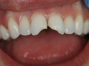 Patient with two broken teeth