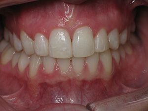 Person with aligned teeth