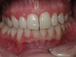 Smile with gap between front teeth