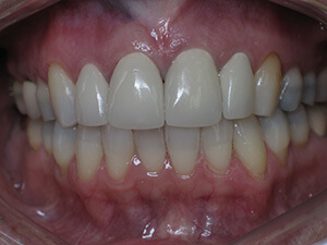 Person with aligned teeth and no gum damage