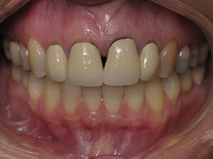 Person with gaps in teeth with slight gum damage