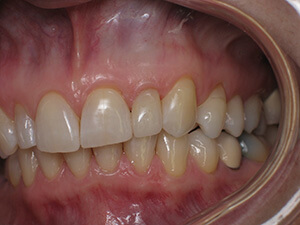 Person with now fixed tooth