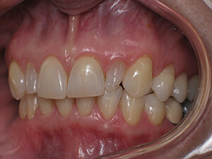 Person with malformed tooth