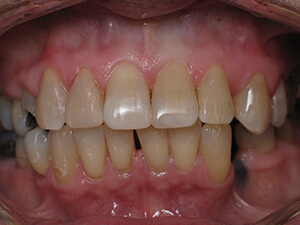 Person with now stain-free teeth