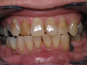 Person with very stained teeth