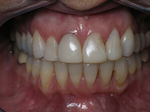 Person with yellow stained teeth