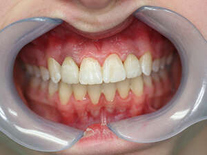 Patient with aligned teeth with zero gaps