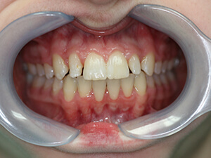 Patient with gaps between teeth