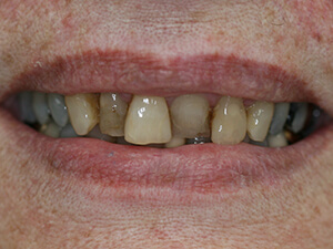 Person with very stained and crooked teeth