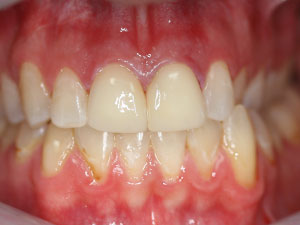 Person with restored front teeth