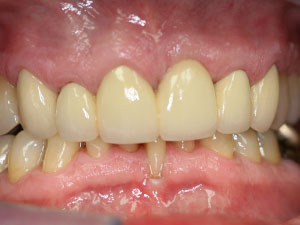 Person with healthy teeth with no gaps