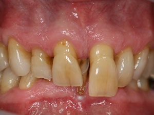 Person with severe gaps and extruded teeth