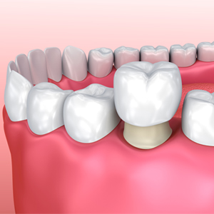 Digital image of a dental crown fitting over a back tooth