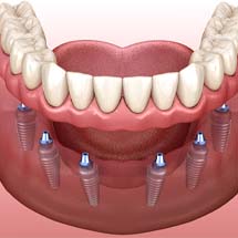 Diagram of an implant denture