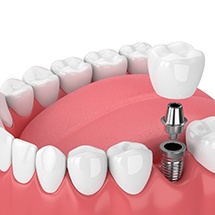 dental implant with a crown 