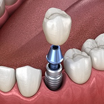 single dental implant with a crown 