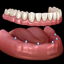 six dental implants holding a denture 