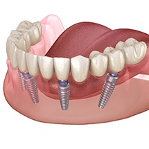 four dental implants holding a denture 
