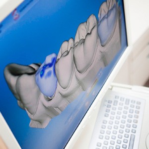 Digital bite impression and dental crown design