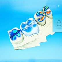 Digital impressions of three teeth