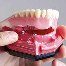 Person holding model of dental implant-retained dentures