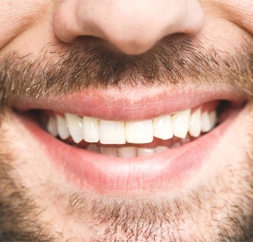 Closeup of smile after tooth colored filling restoration