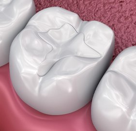 Animated smile with tooth colored fillings