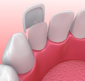 Animated smile during porcelain veneer placement